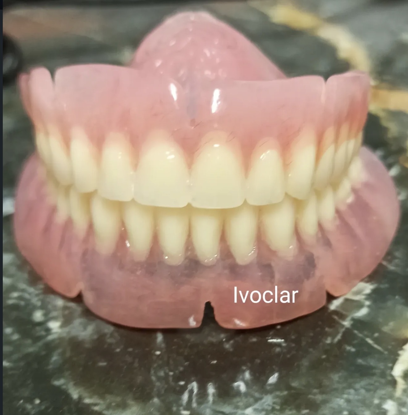 Prothèse complète en résine, teintes naturelles, matériau Ivoclar